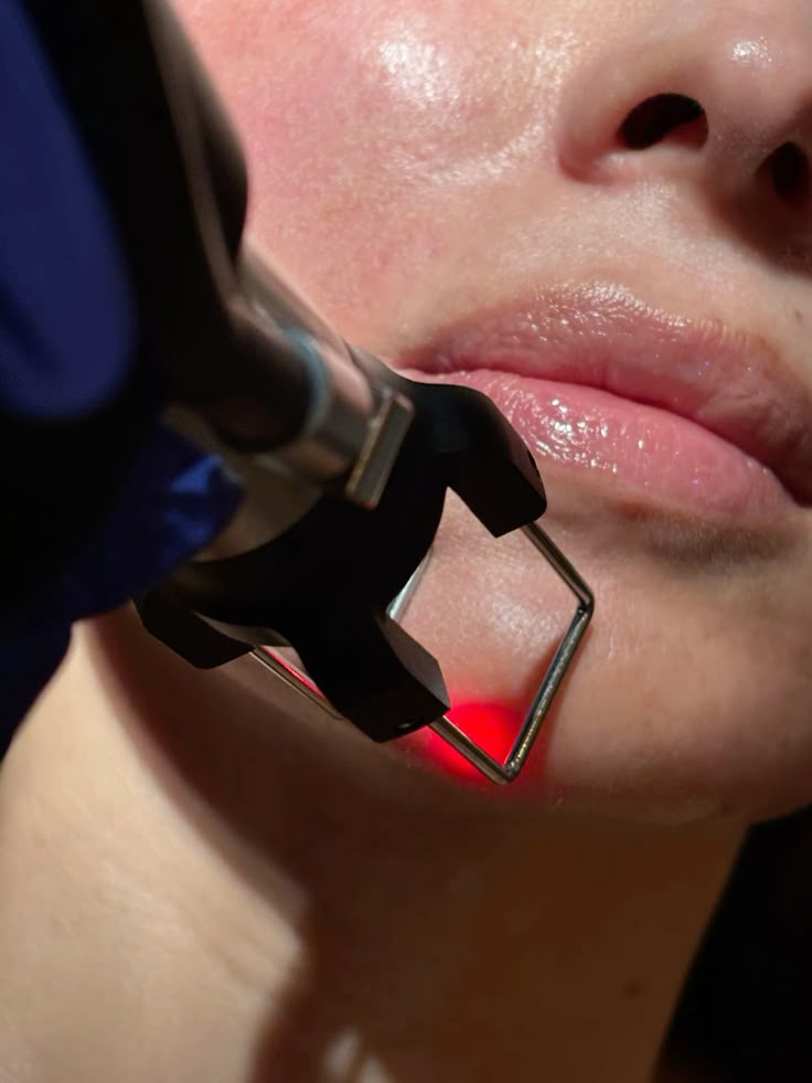 LASERSKI TRETMANI ZA SMANJENJE OŽILJAKA